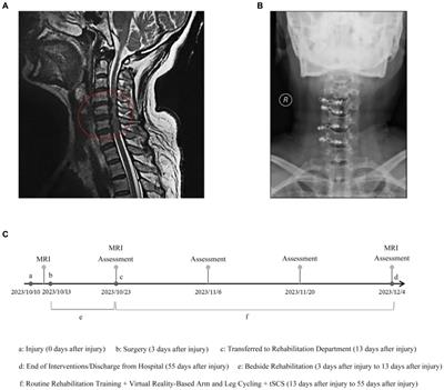 Case report: Virtual reality-based arm and leg cycling combined with transcutaneous electrical spinal cord stimulation for early treatment of a cervical spinal cord injured patient